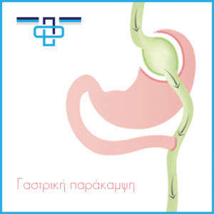 Πριν και μετά τη γαστρική παράκαμψη (γαστρικό bypass) 3