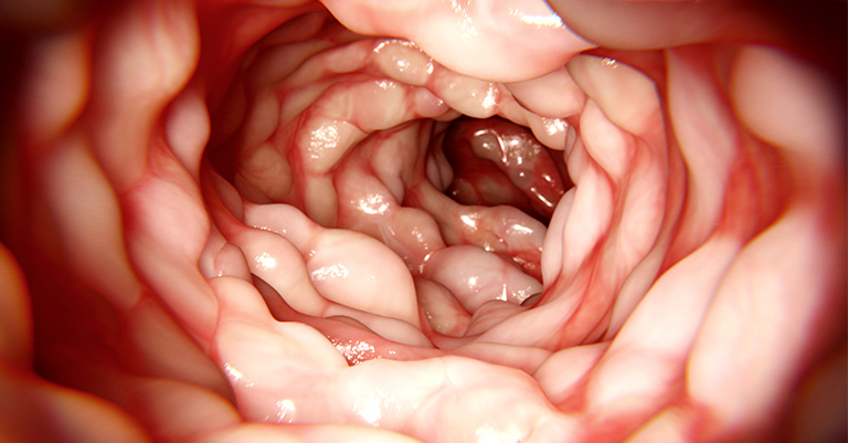 Νόσος του Crohn