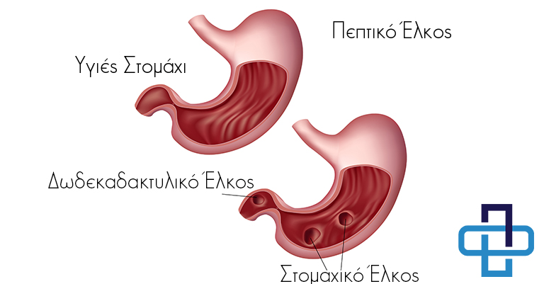 Πεπτικό Έλκος
