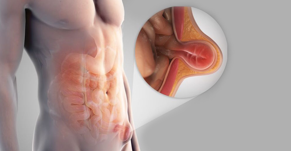 Inguinal hernia