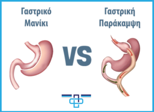 Επιμήκης γαστρεκτομή ή γαστρική παράκαμψη