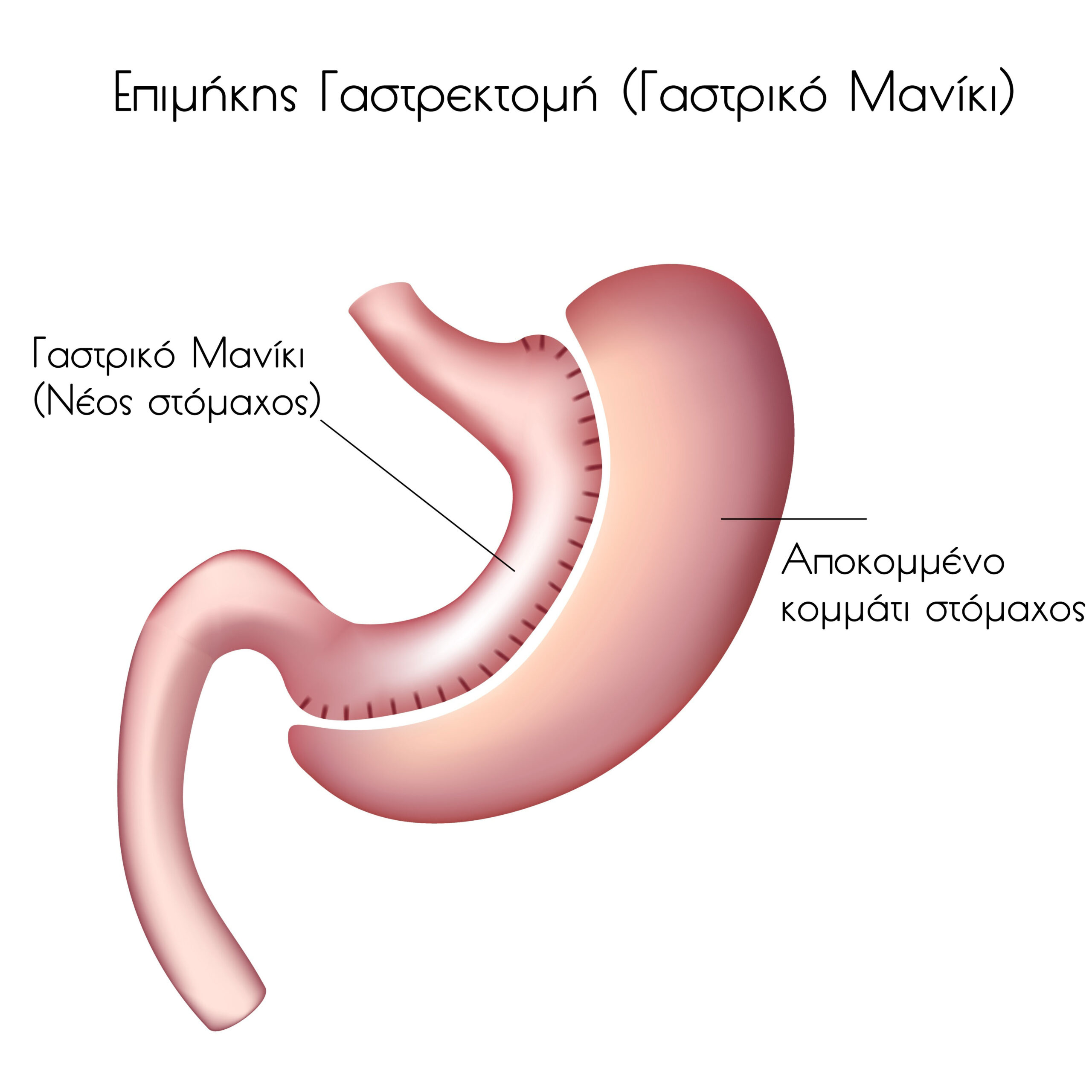 Επιμήκης Γαστρεκτομή (γαστρικό μανίκι) 1 Γαστρικό Μανίκι