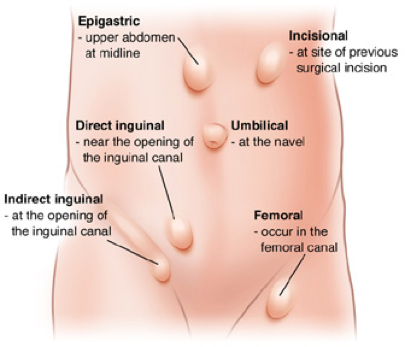 hernia
