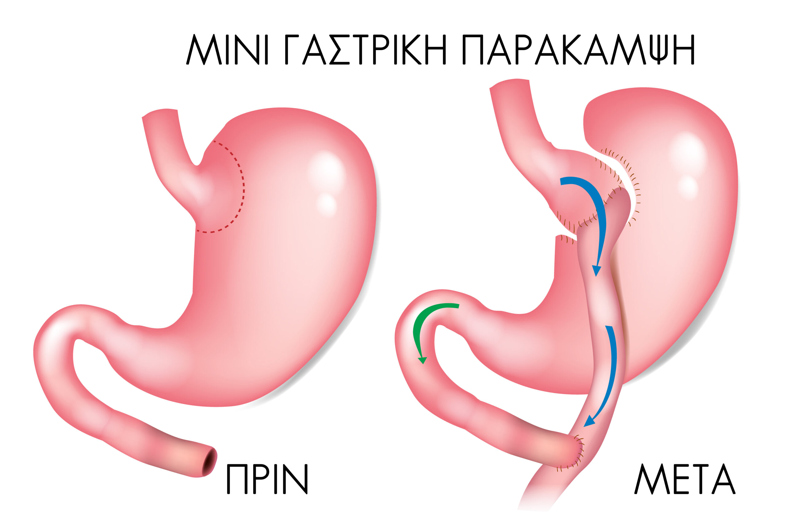 Γαστρική Παράκαμψη μιας αναστόμωσης 1 Γαστρική Παράκαμψη μίας Αναστόμωσης