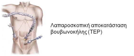 Χειρουργική Κηλών 4 Χειρουργική Κηλών