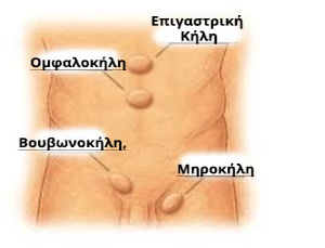 Χειρουργική Κηλών 2 Χειρουργική Κηλών