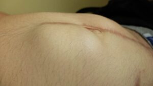 Κήλη στην κοιλιά 11