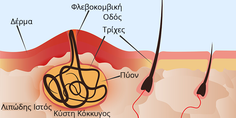 Κύστη Κόκκυγος