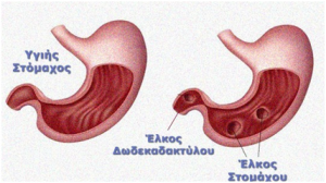 Πεπτικό Έλκος