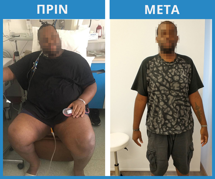 Χειρουργική Παχυσαρκίας 17 Χειρουργική Παχυσαρκίας 16